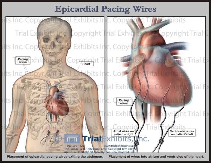 Epicardial wires removal chest pain